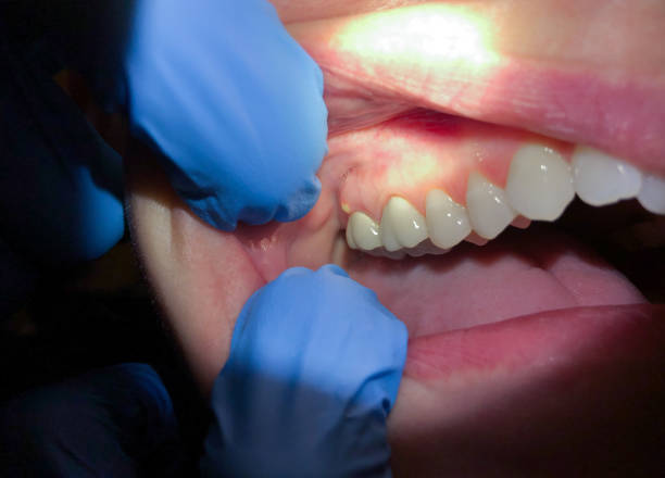 Tooth Infection Emergency Dentist in OK