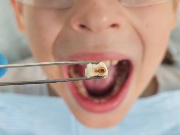 Best Knocked-Out Tooth Emergency  in Coalgate, OK